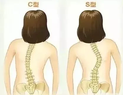 8歲男孩脊椎側(cè)彎